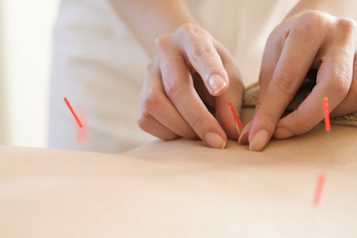 Women undergoing acupuncture waist